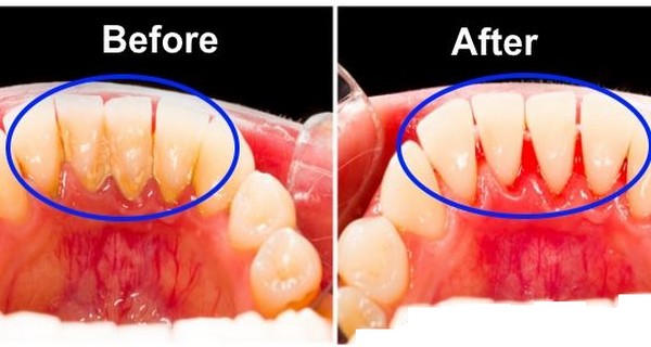 Homemade recipes to effectively remove plaque from your teeth