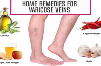 10 Miraculous Home Remedies To Make Varicose Veins Disappear Naturally