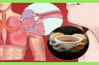 8 home remedies to treat bronchitis and stop painful coughing attacks